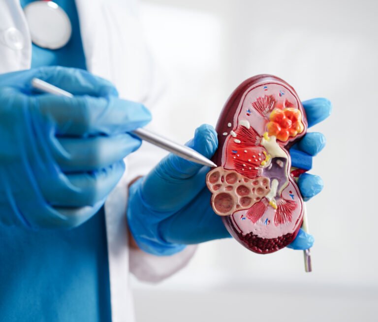 Chronic kidney disease, doctor holding model for treatment urina