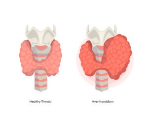 Hyperthyroidism Doctor